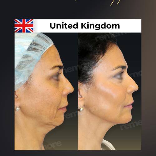 Photos Avant / Après 4